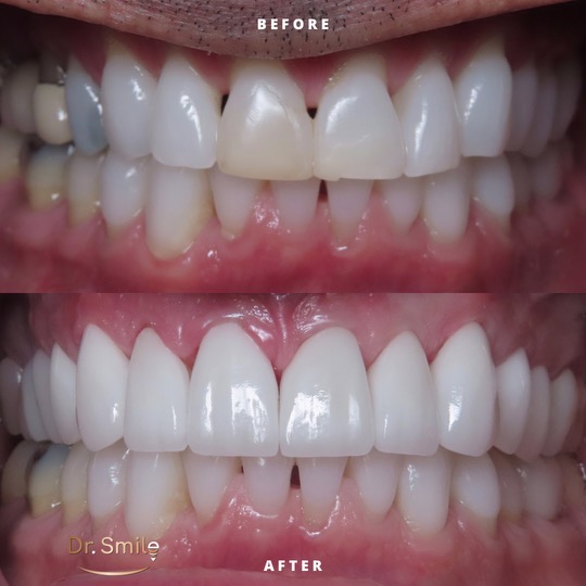 Complex restorative