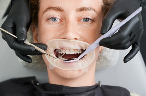 What to Expect During Full Mouth Restoration in Lomita